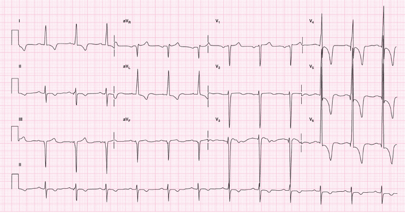 print-ecg-s-chapter-7-pictures-flashcards-easy-notecards