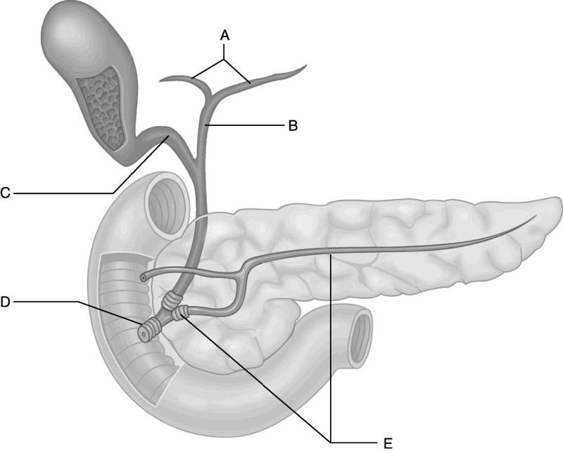 Отсос простата. Вирсунгов проток поджелудочной железы. Панкреатический проток анатомия. Вирсунгов проток анатомия. Схема протоков поджелудочной железы.