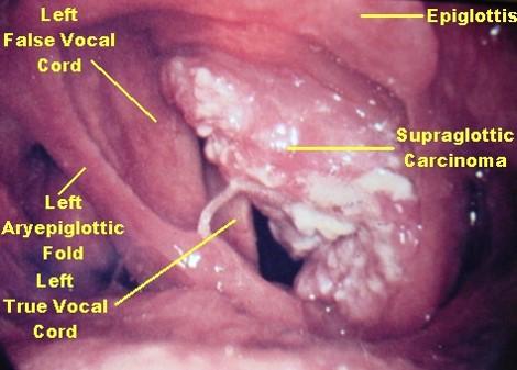 Path: ENT Flashcards | Easy Notecards diagram of squamous cell carcinoma 