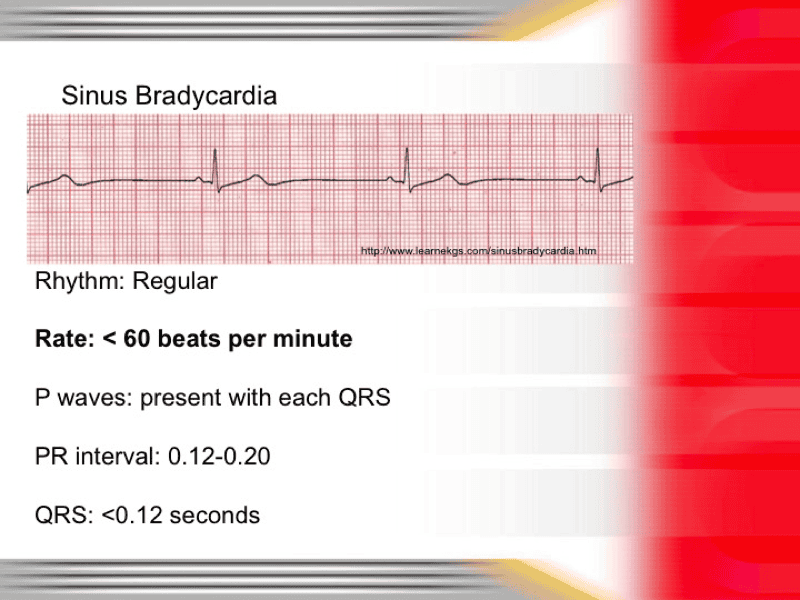 print-ekg-and-arrhythmia-flashcards-easy-notecards