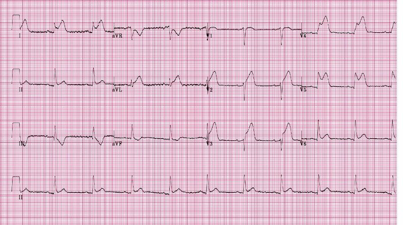 Print Medicine: ECG Findings in ACS flashcards | Easy Notecards