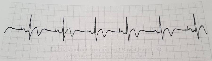 type 2 atrial flutter icd 10