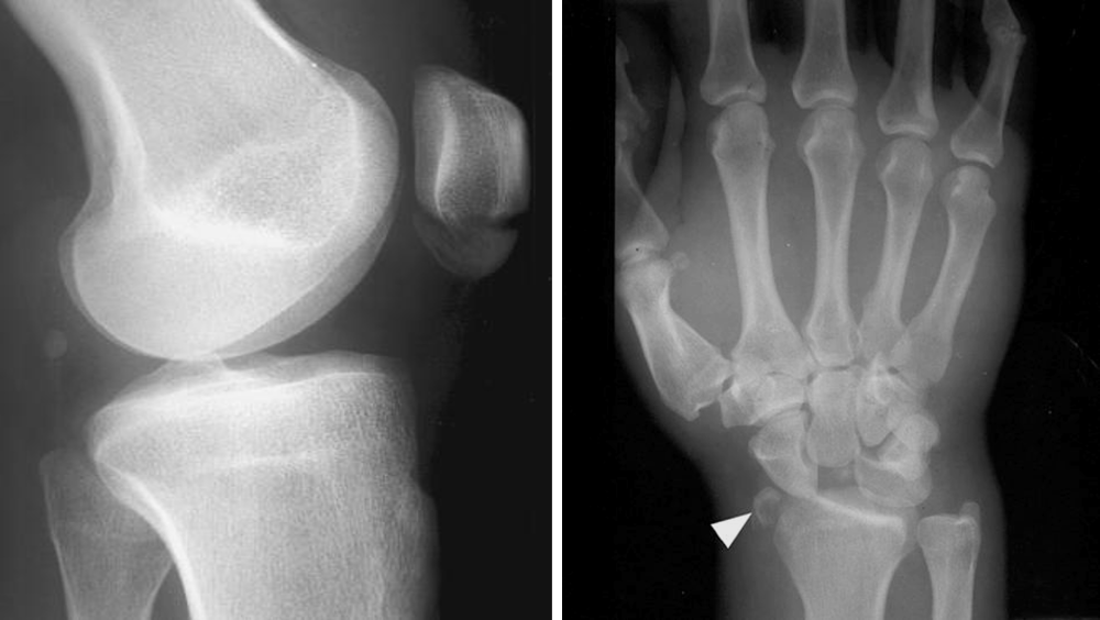 what-causes-wrist-bone-to-stick-out