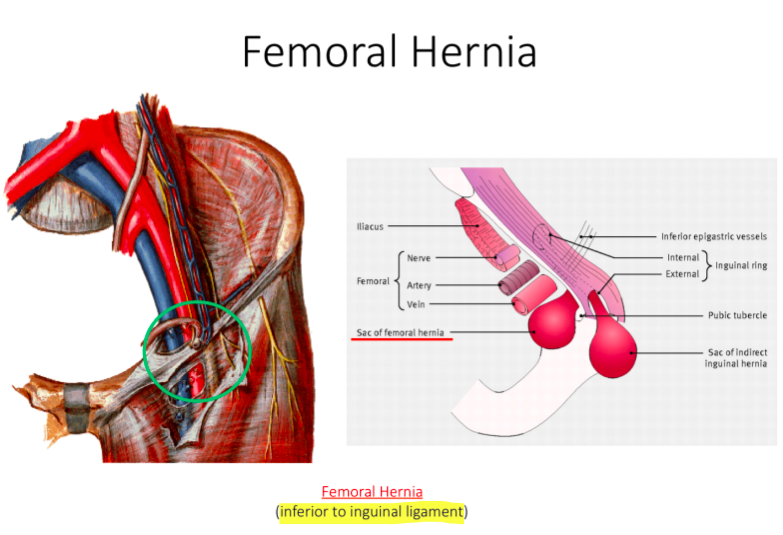 Hernia перевод с латинского. Бедренная грыжа у девочки.