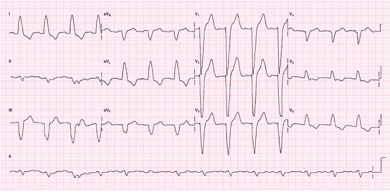 ECG's Chapter 9 (Pictures) Flashcards | Easy Notecards