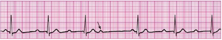 Printable Acls Flash Cards