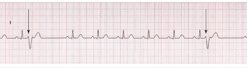 Print Ecg S Chapter 10 Pictures Flashcards Easy Notecards