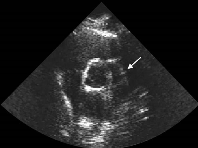 Grating Lobes Ultrasound