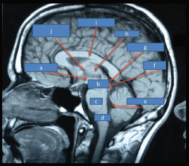 Print Neuro Block II- MRIs and sections flashcards | Easy Notecards