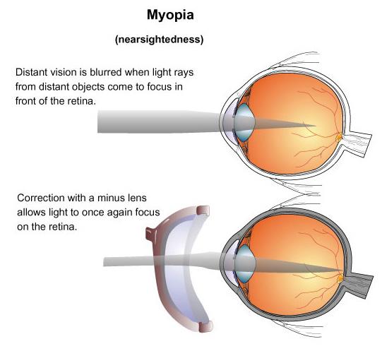 what are the types of refractive errors