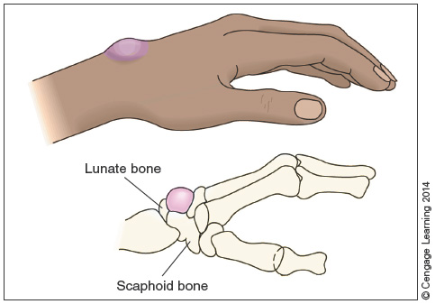 Chapter 21 Orthopedic Pathologies Flashcards | Easy Notecards