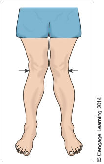 Chapter 21 Orthopedic Pathologies Flashcards | Easy Notecards